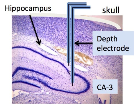 Illustration of bipolar depth electrode implanted into the CA3 region of the hippocampus.