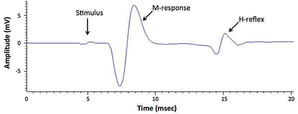 Stimulation of the tibial nerve at the ankle results in a short-latency M-response in the plantar foot muscle followed by an H-response approximately 7 msec later.